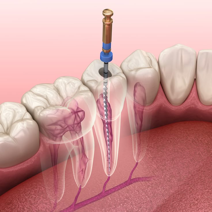 Painless Root Canal Treatment Vasai East